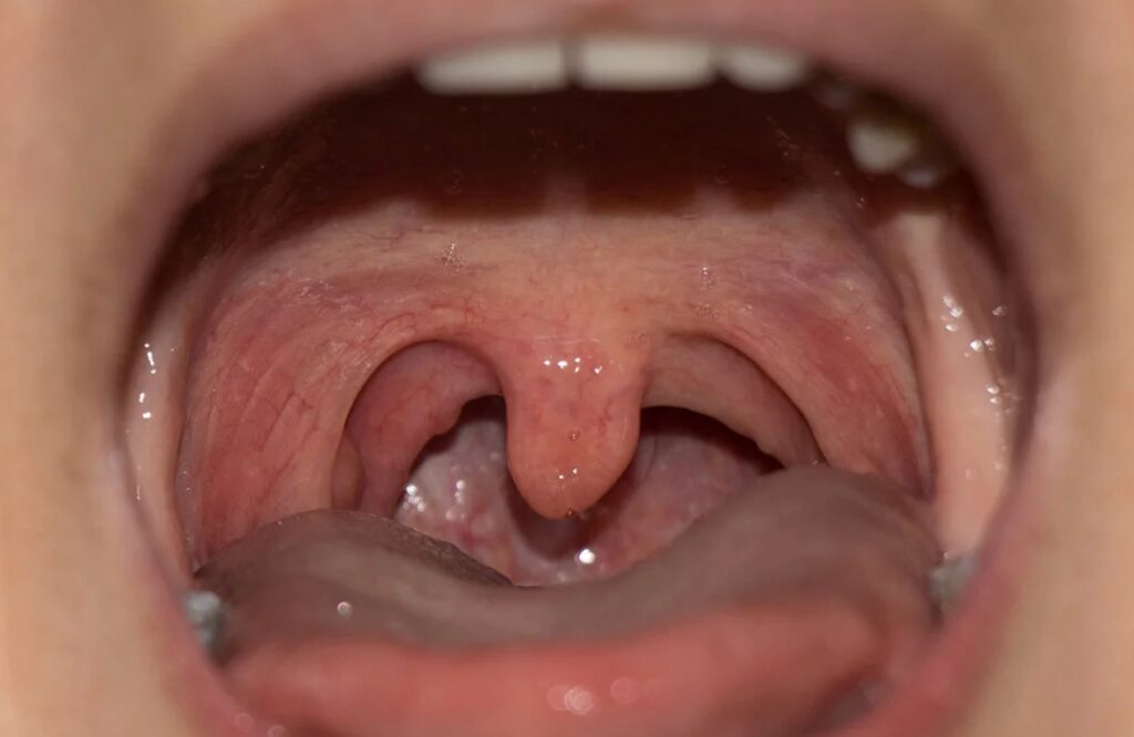 uvula (küçük dil) ödemi - ceviz alerjisi